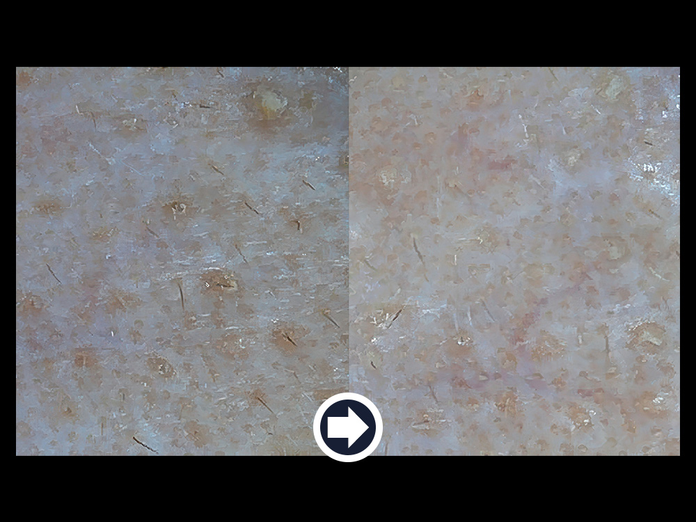 Pore impurity comparison